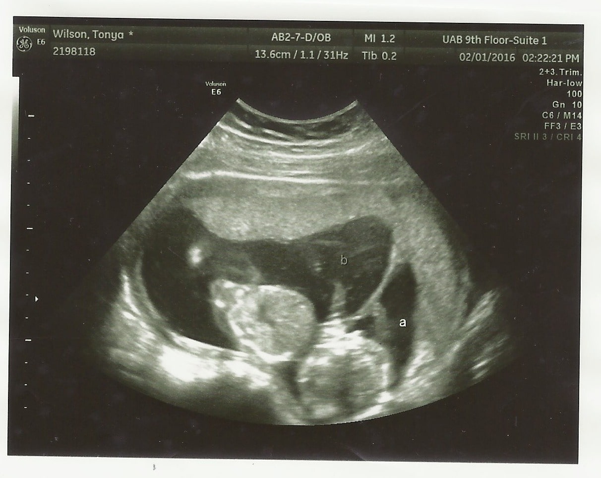 Weeks Pregnant Twins Ultrasound