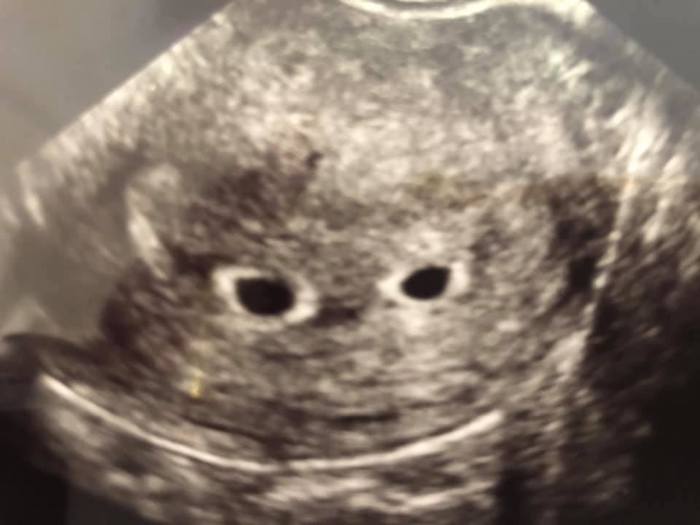 5 Weeks Pregnant With Twins Symptoms Belly And Ultrasound About Twins