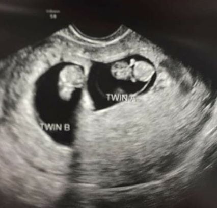 7 Weeks Pregnant Ultrasound Twins