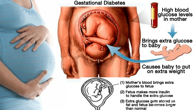 Gestational diabetes can be prevented in high-risk women 