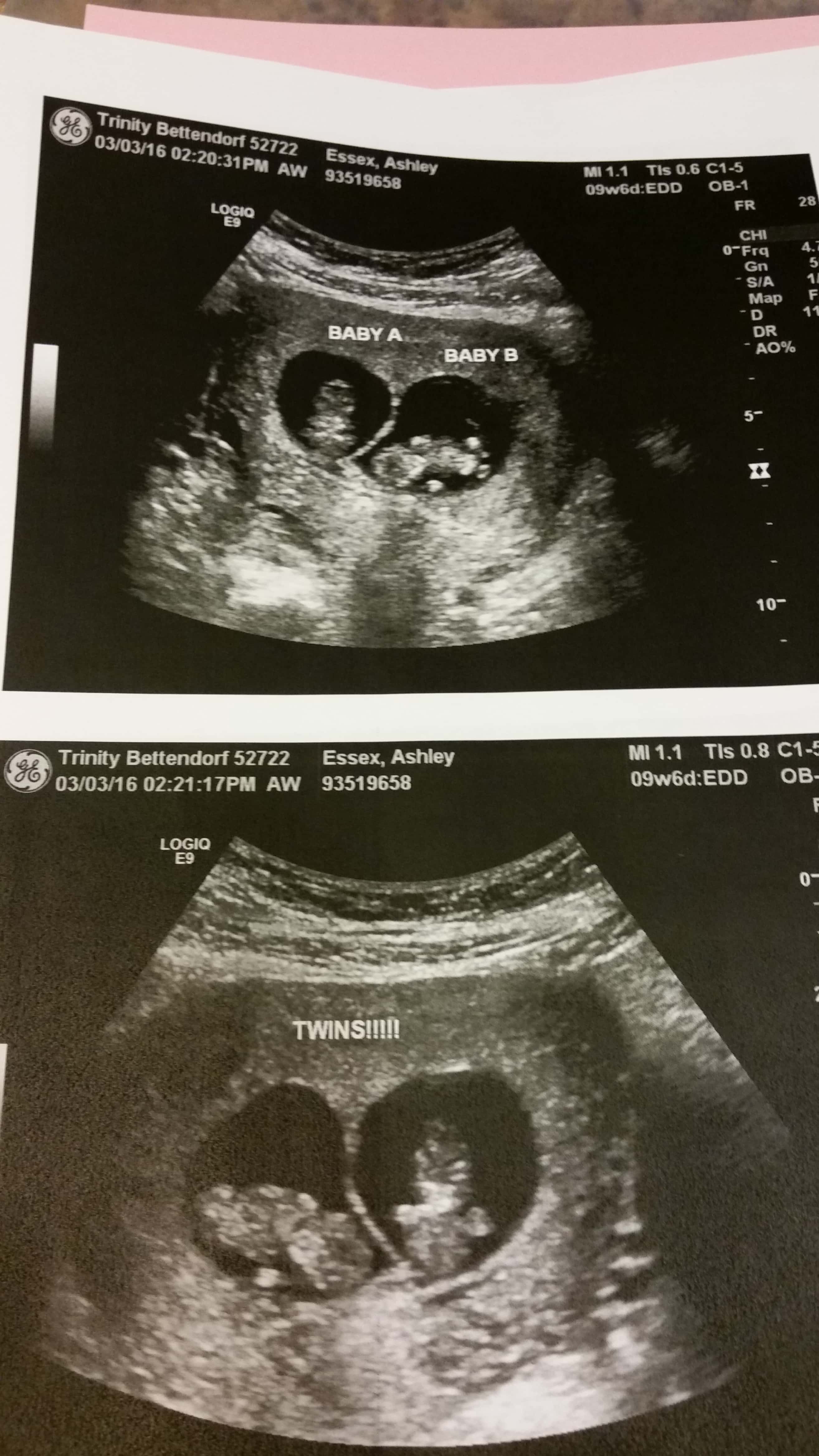 identical twins ultrasound 10 weeks