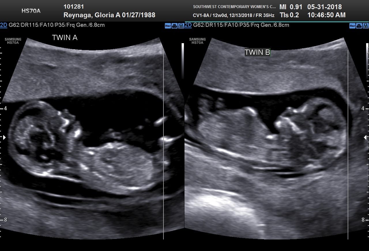 13 Weeks Pregnant Ultrasound Twins