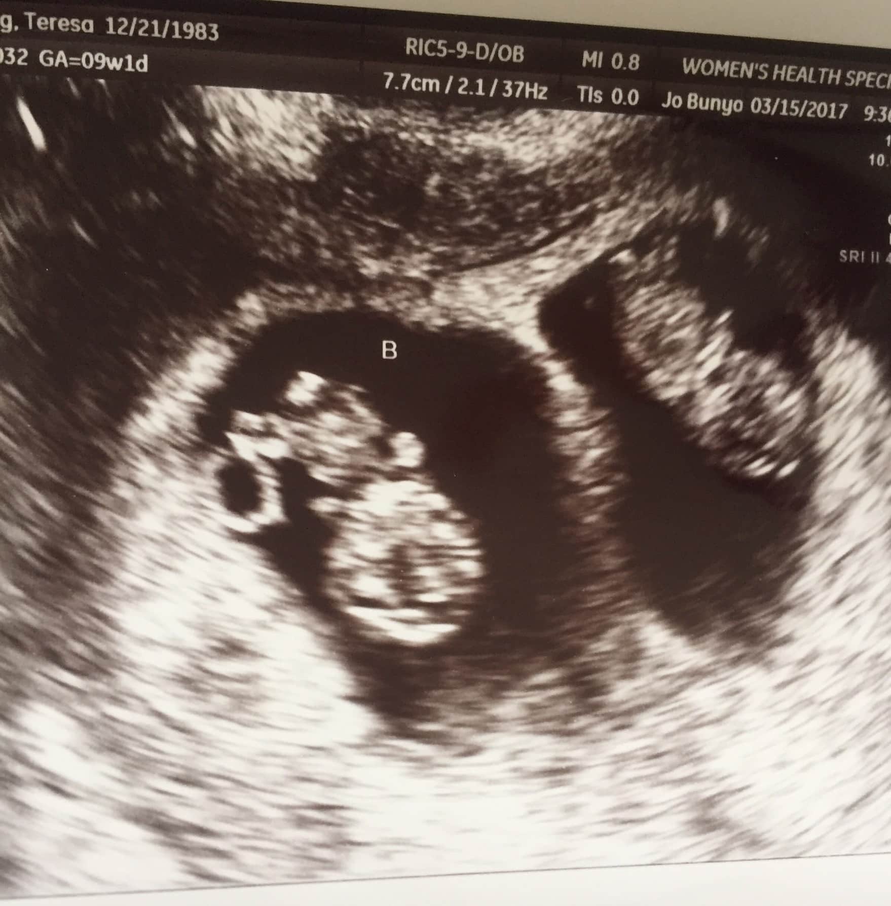 Identical Twins Ultrasound 12 Weeks