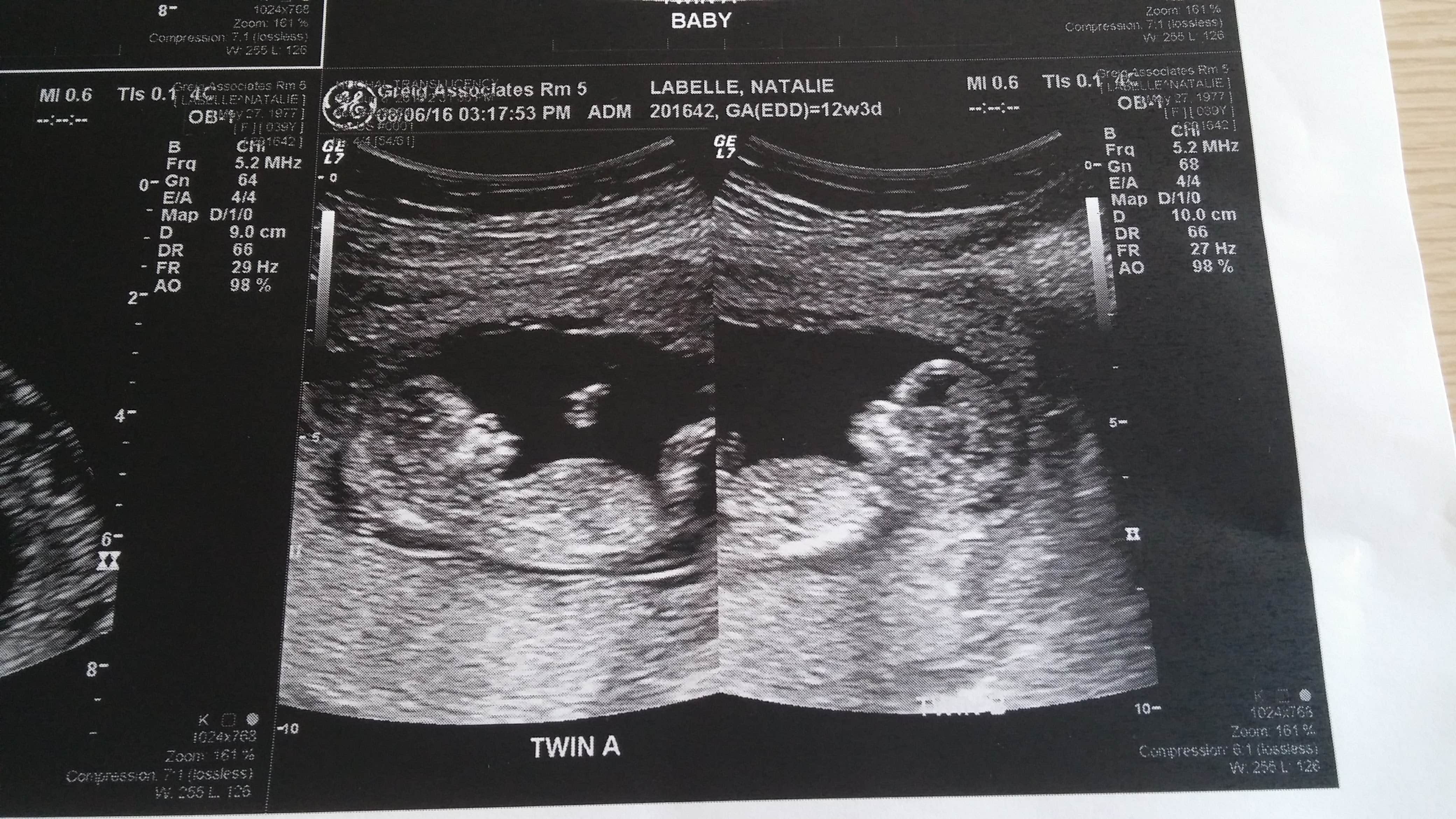 12 Weeks Pregnant Ultrasound Twins