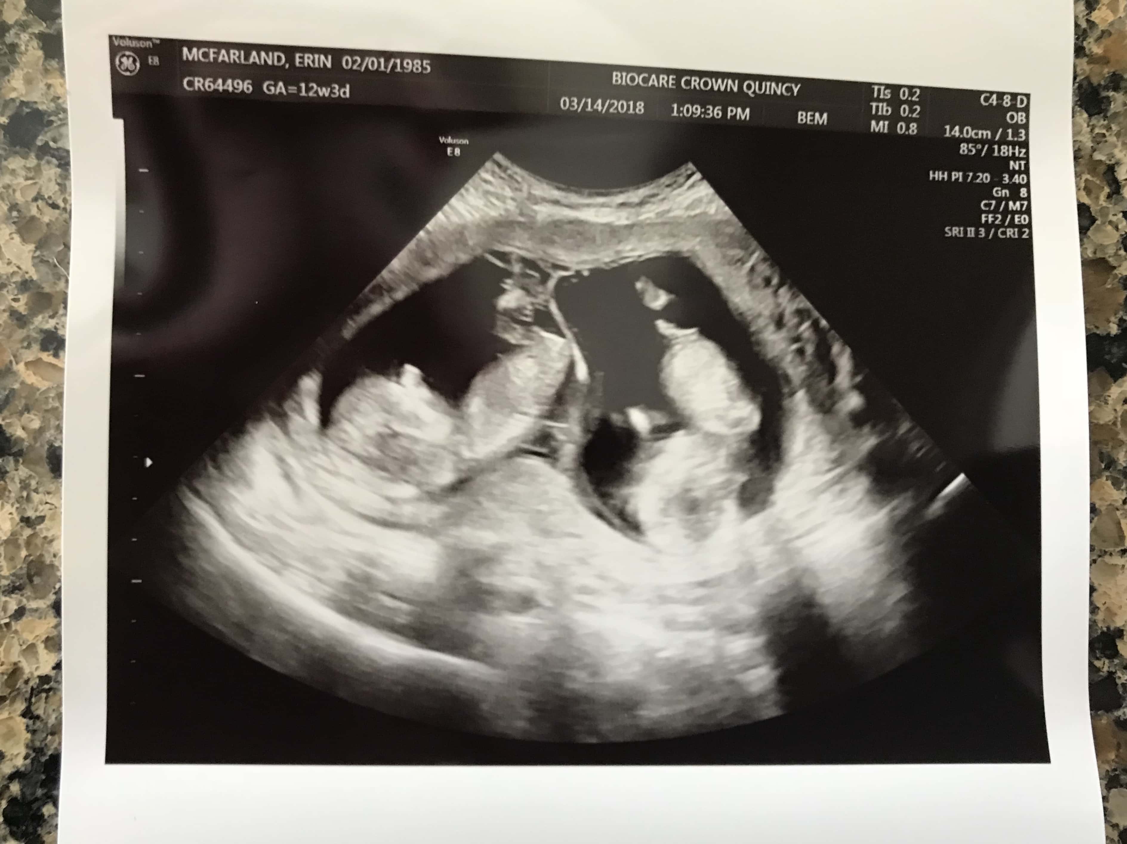 normal heartbeat at 12 weeks