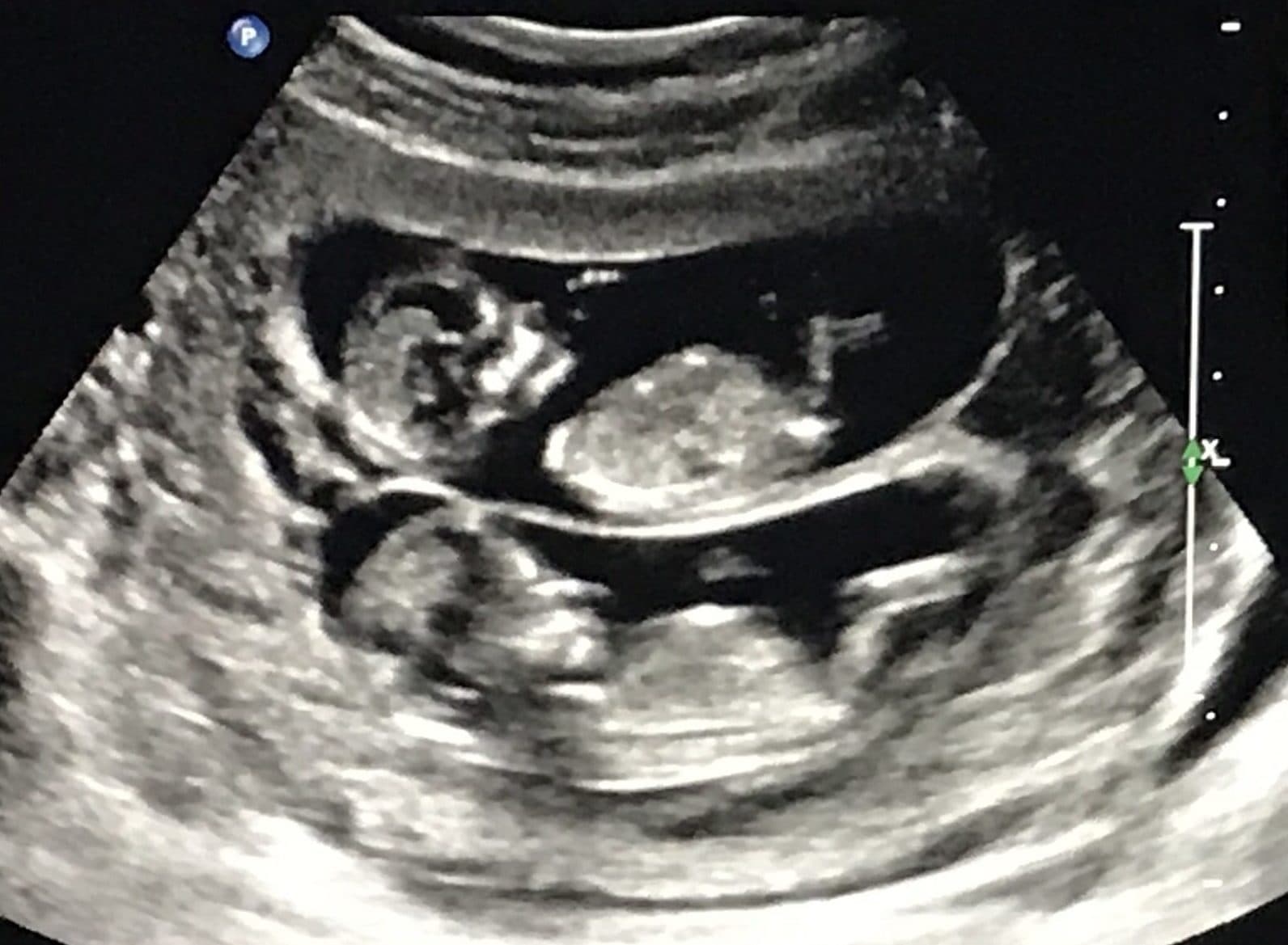 13 Weeks Pregnant Ultrasound Twins