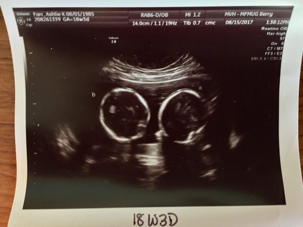 Did You Find Out It Was Twins At A Later Ultrasound? 