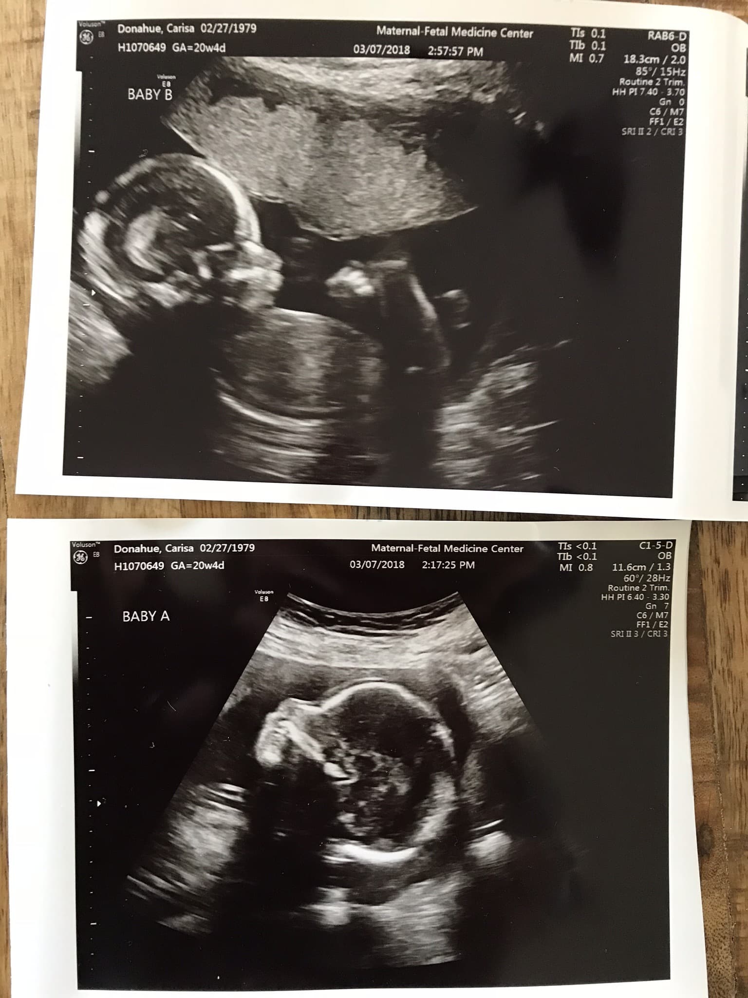 twin 3d ultrasound 20 weeks