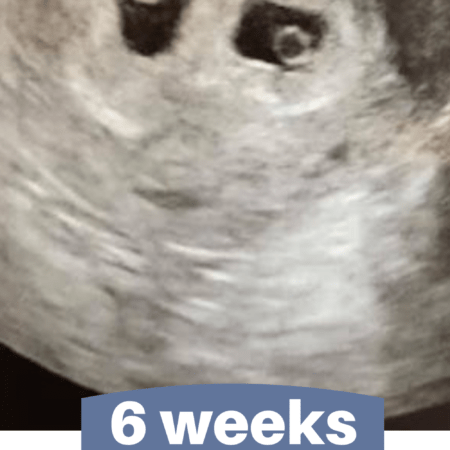 6 week ultrasound pictures