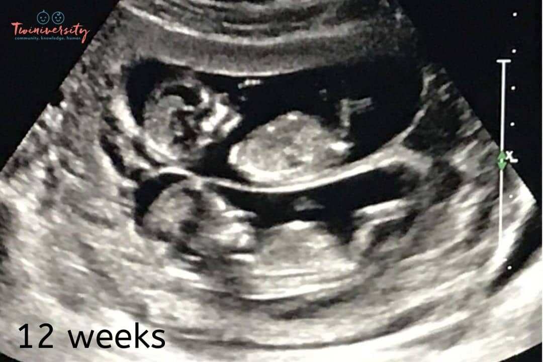 identical twins ultrasound 8 weeks