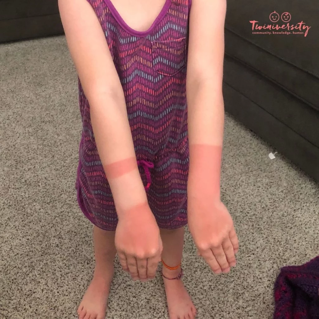 Child with a mild sunburn on her arms