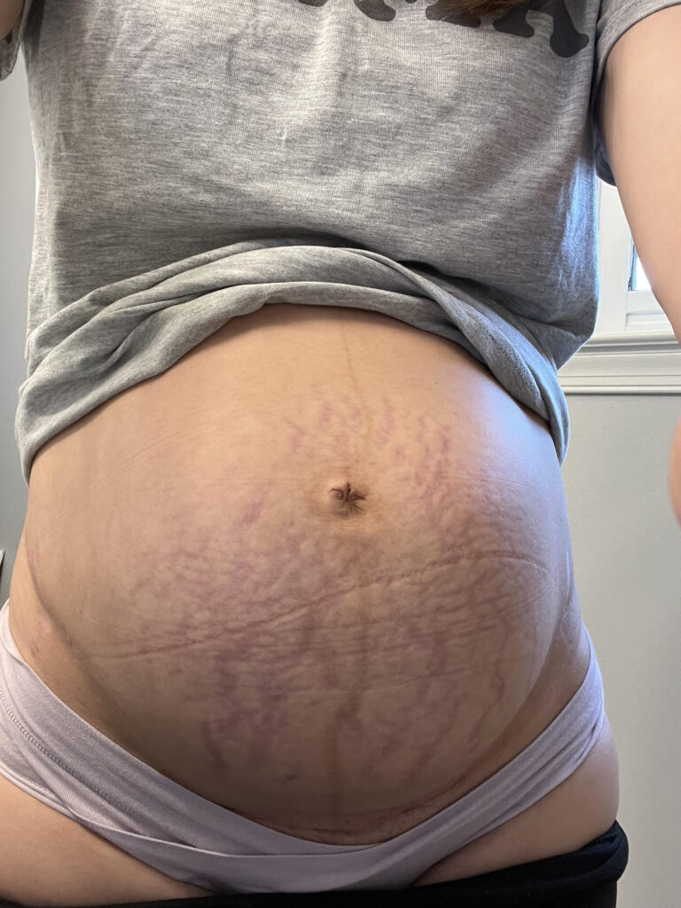 post c section belly