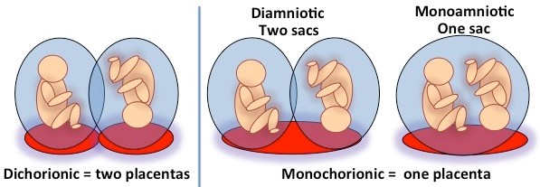 monochorionic diamniotic twins 