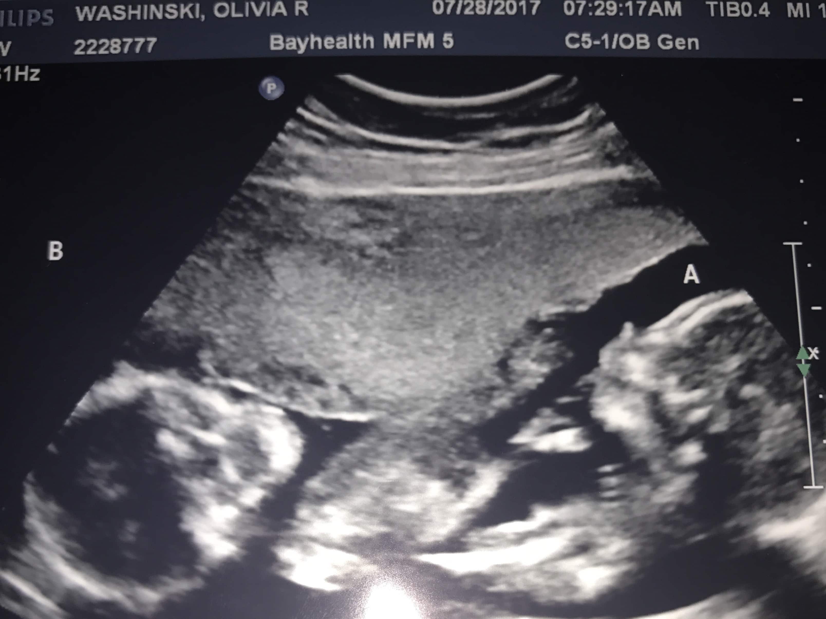 20 weeks ultrasound twins