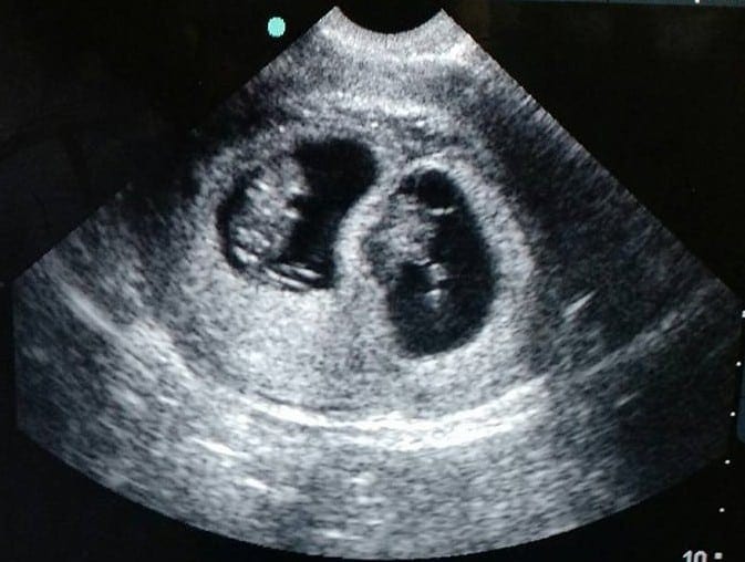 Ultrasound Photos - 8 week sonogram. 