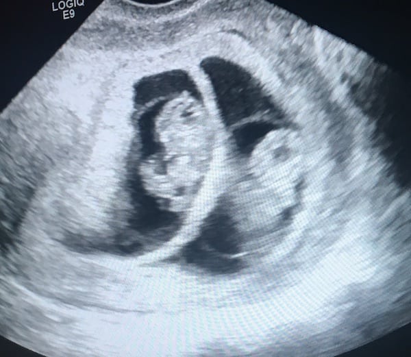 sonogram of twins at 8 weeks