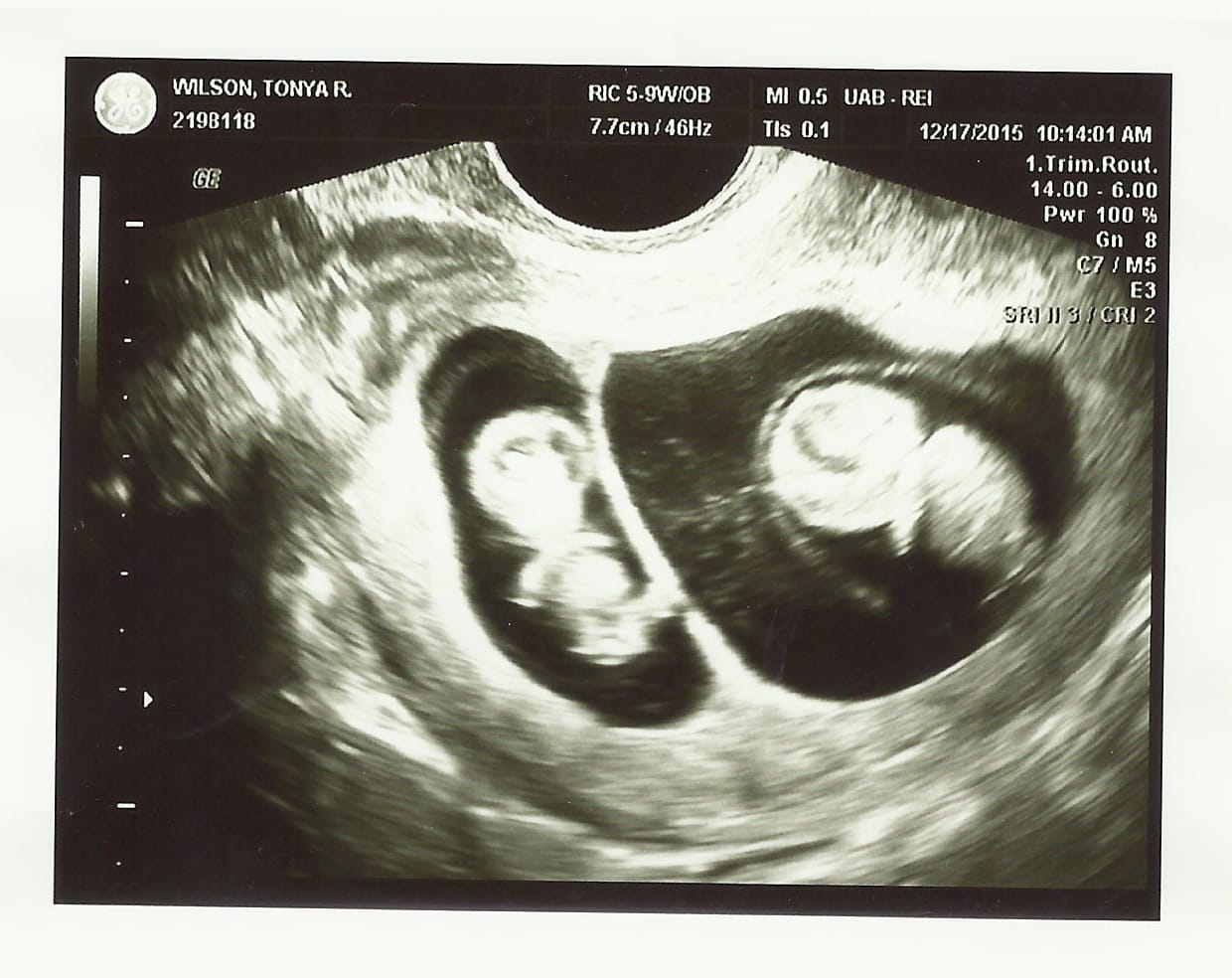 9 Weeks Ultrasound 1 Twiniversity