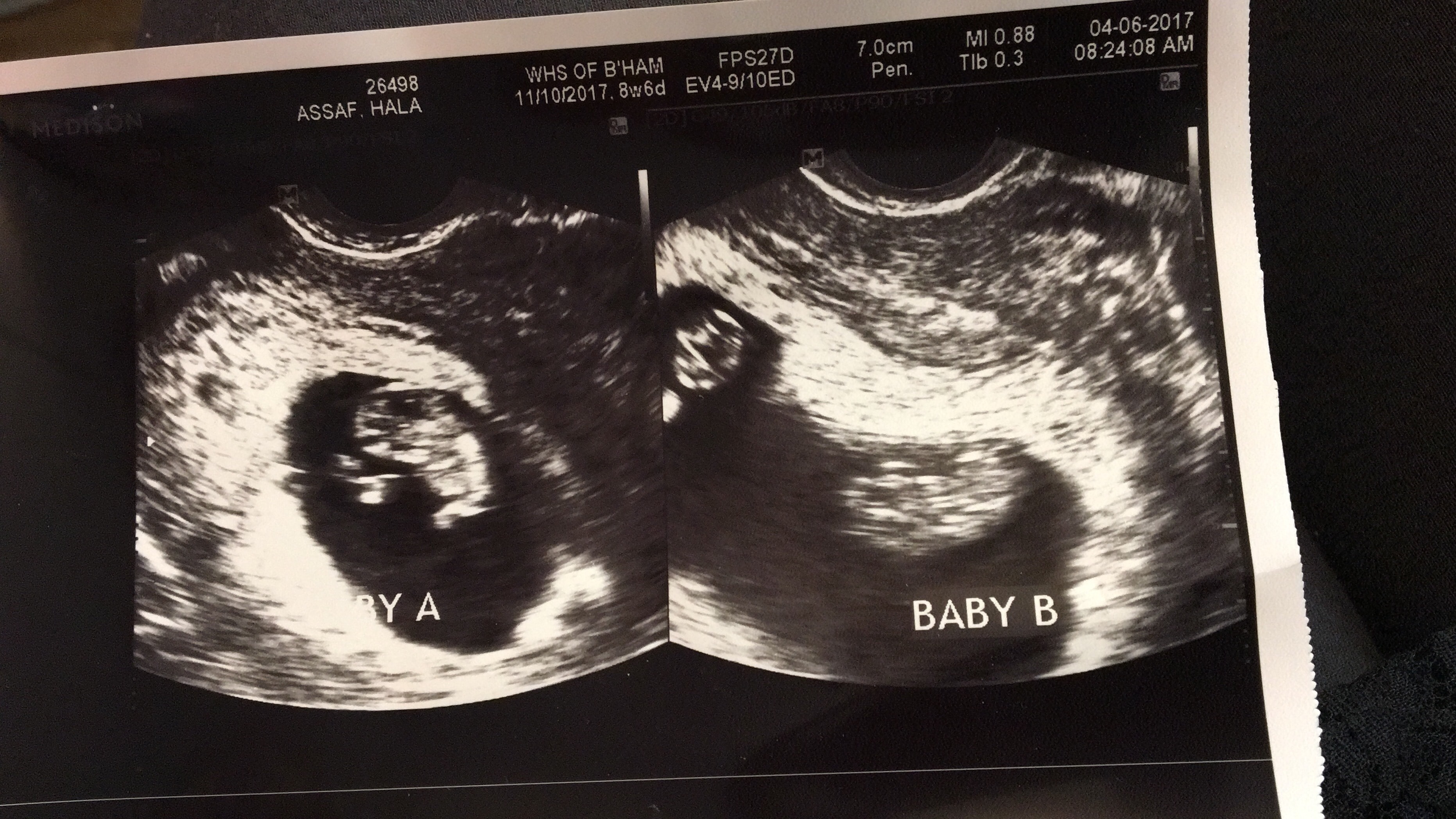 9 Week Ultrasound Twins