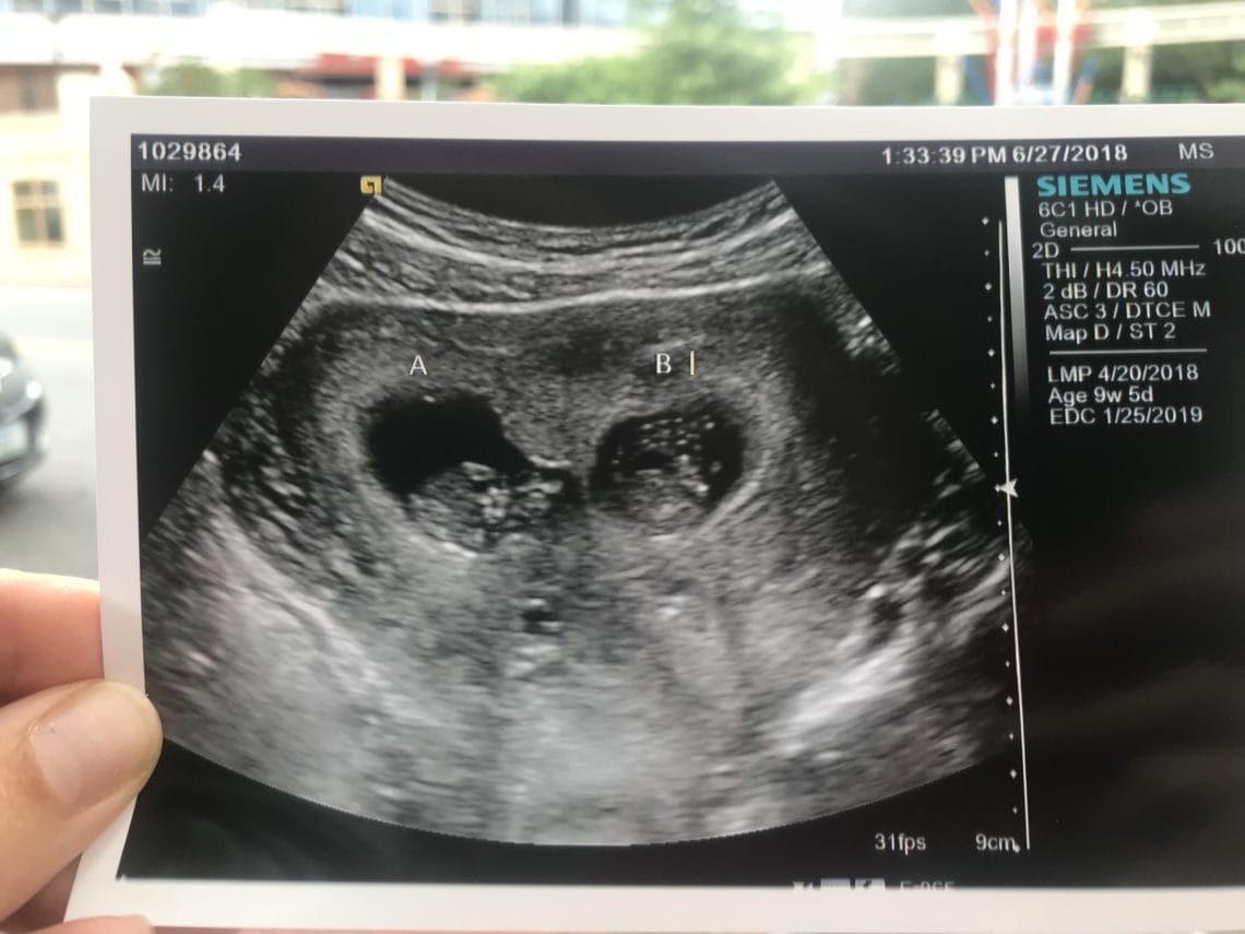 9wks ultrasound - Twiniversity