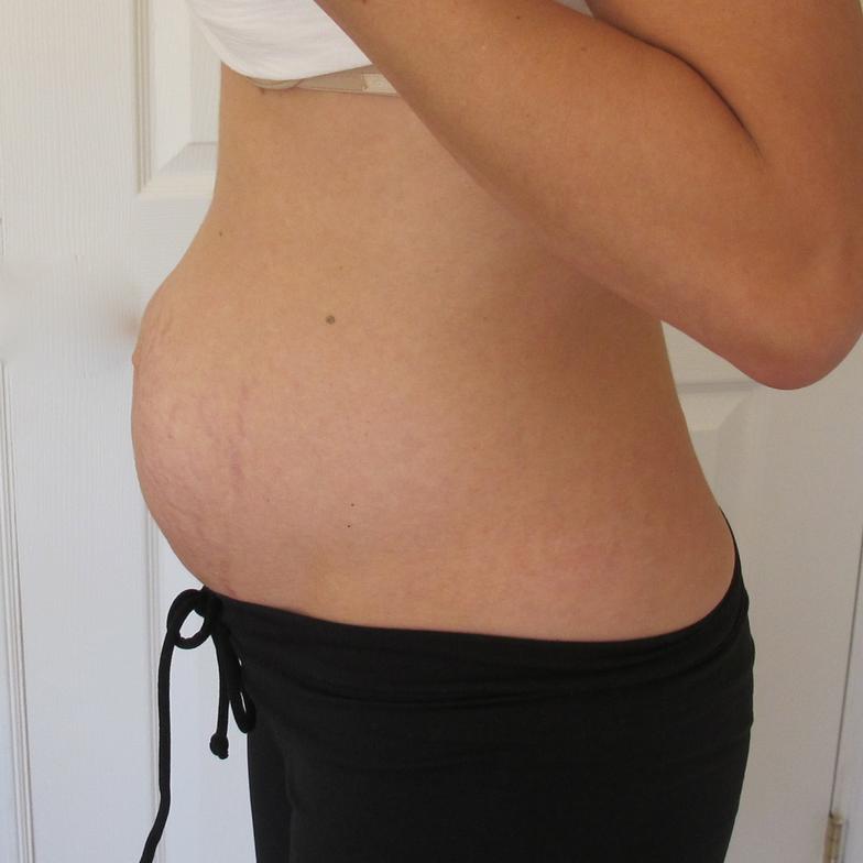 I'm Pregnant and Huge - A Diastasis Recti Story