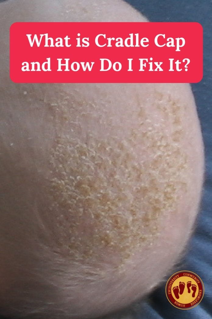 what-is-cradle-cap-and-how-do-i-fix-it-twiniversity