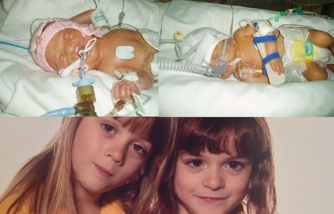 A Beautiful Gallery Of Preemie Twins: Before And After! - Twiniversity