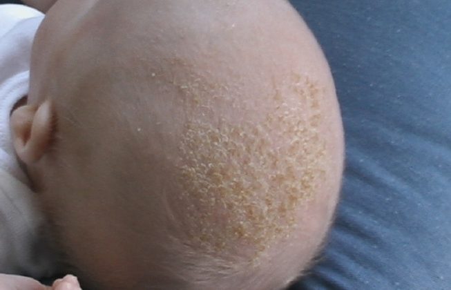 What is Cradle Cap and How Do I Fix It? - Twiniversity