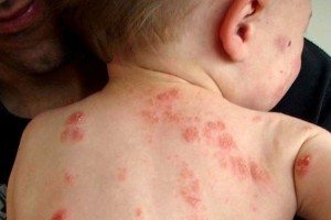 eczema baby treatments